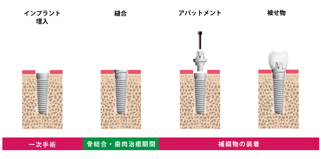 インプラントの手術方法 和光市で受けるインプラント インプラント治療専門サイト